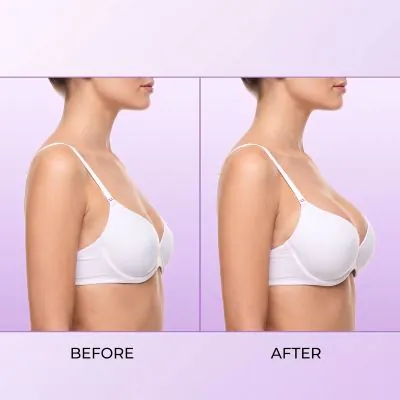 Breast Augmentation Result In Dubai