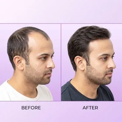 Hair Transplant Result In Dubai