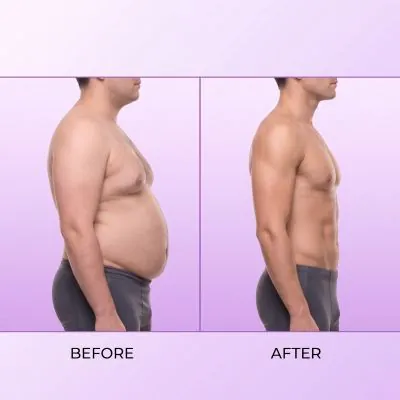 Liposuction & Gynecomastia Result In Dubai