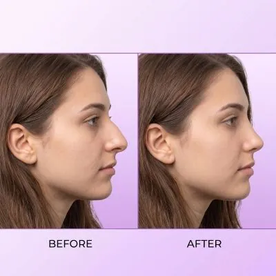 Nose Reshaping Rhinoplasty Result In Dubai