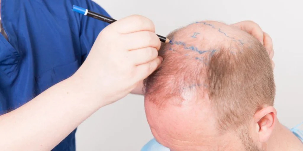 Hair Transplant in Dubai