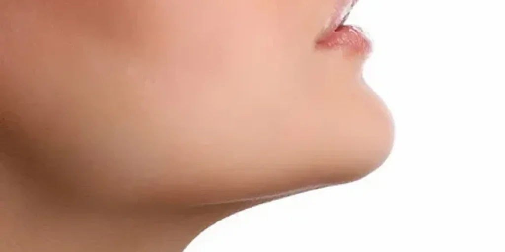 Chin Fat Transfer in Dubai
