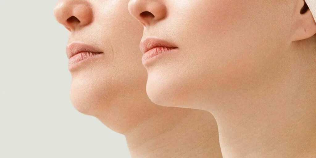 Chin Fat Transfer In Dubai