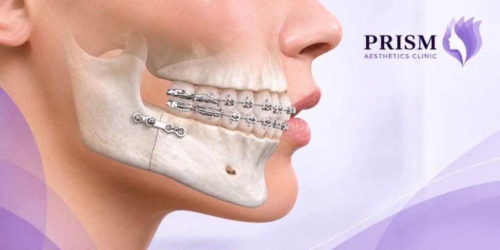 Jawline Surgery in Dubai